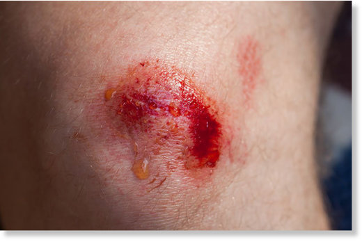 Offene Wunde am Knie: Spülen mit Salzwasser hilft gegen eine Infektion.