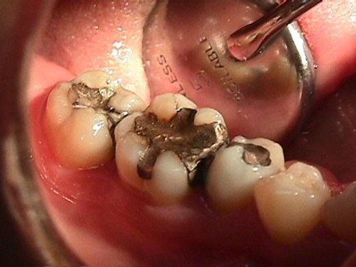 amalgamas_dentales