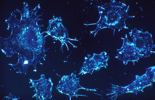 cancer cells - Krebszellen