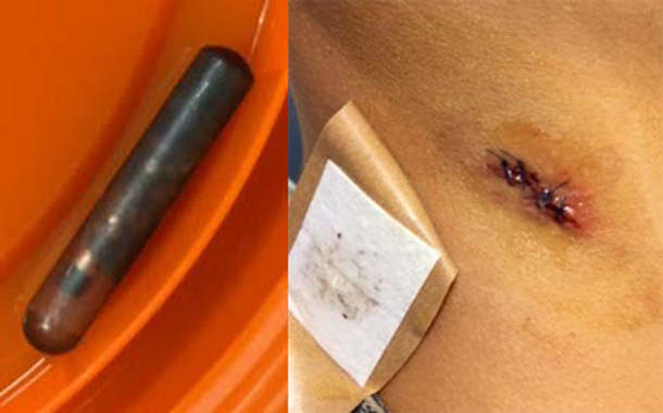 OP-Wunde RFID-Chip,Sexsklavin RFID-Chip