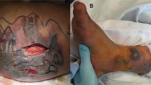 Tödlicher Ausgang Mann geht mit frischem Tattoo baden und wird von