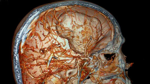 Gehirn des Menschen,Blutkreislauf Gehirn