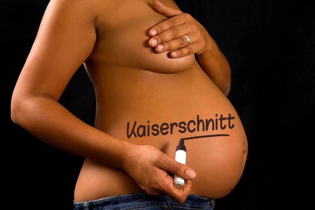 Kaiserschnitt