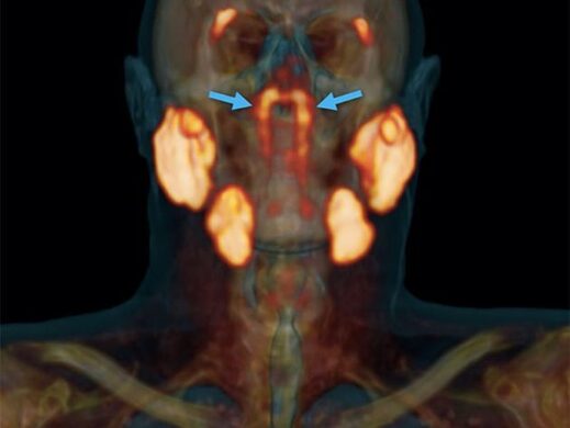 Speicheldrüsen Kopf Nasenrachen tubarial glands Rachenspeicheldrüsen