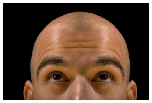 Baldness