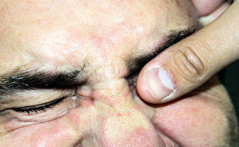 auge, augenverletzungen, drücken