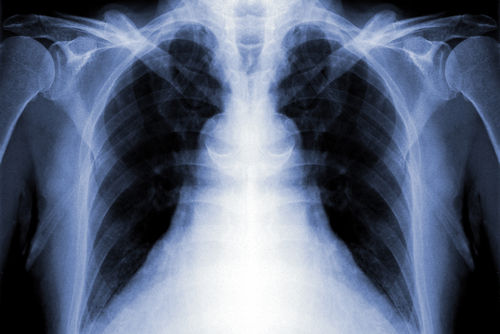 Tuberkulose,Lunge,TB