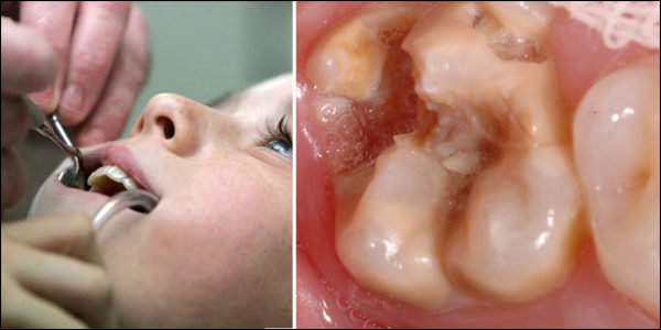 kranke Kinderzähne